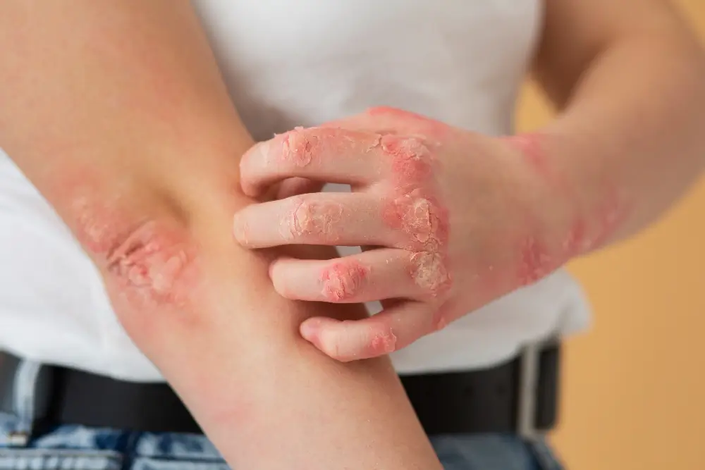 eczema